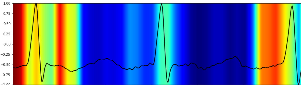 ECG Attention